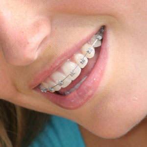 Damon Selbstligierende Brackets · Fachzahnarzt für Kieferorthopädie Witten Peter Brünger