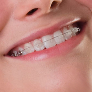 Damon-Clear Keramikbrackets · Fachzahnarzt für Kieferorthopädie Witten Peter Brünger