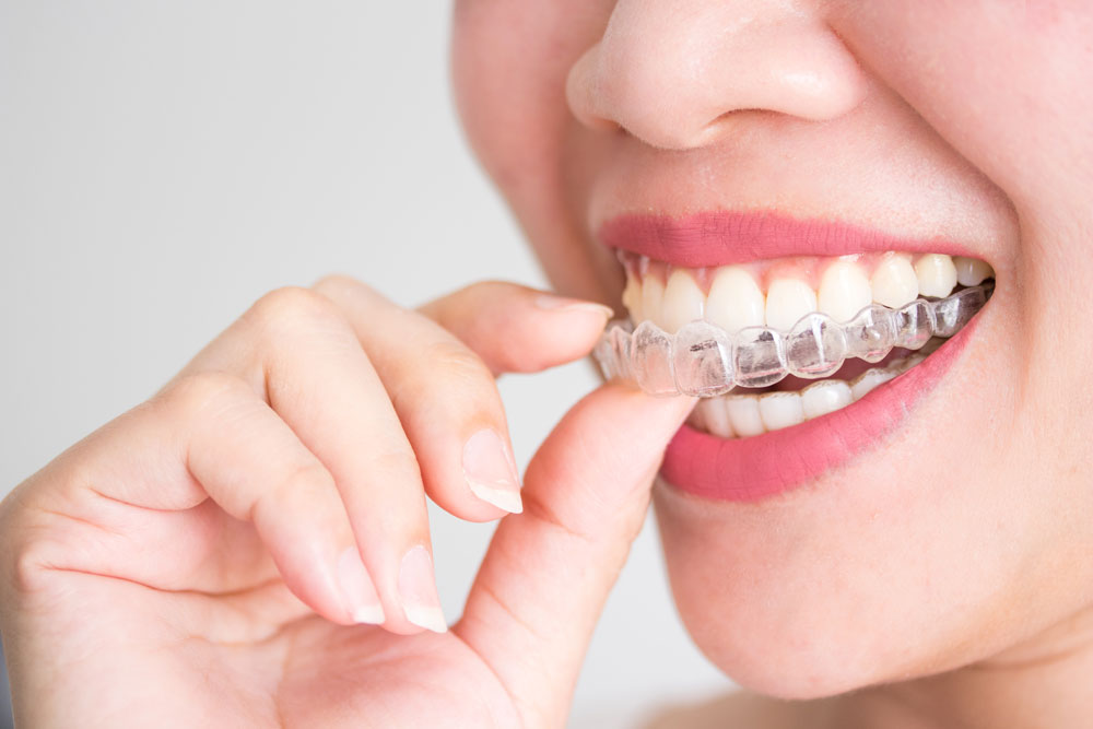 Aligner Zahnschiene · Fachzahnarzt für Kieferorthopädie Witten Peter Brünger